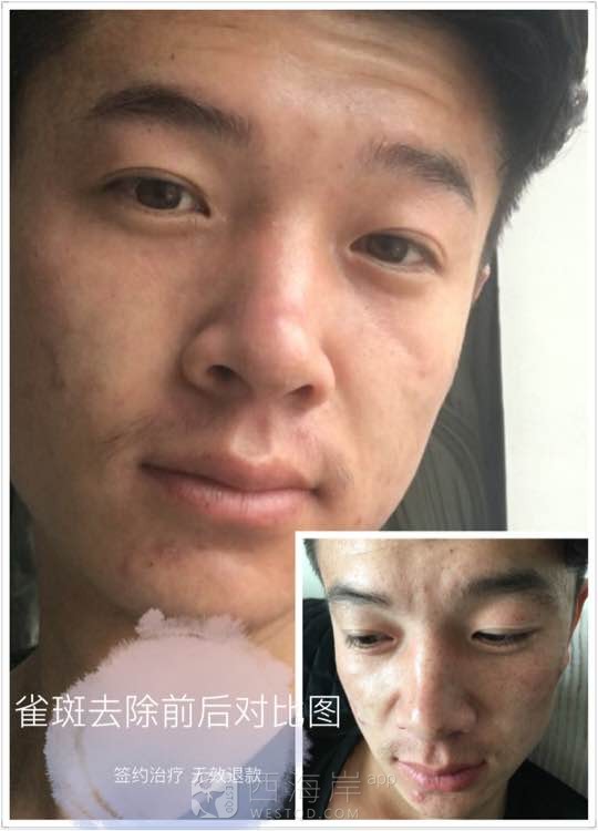 [美容健身]黄岛有雀斑的吗