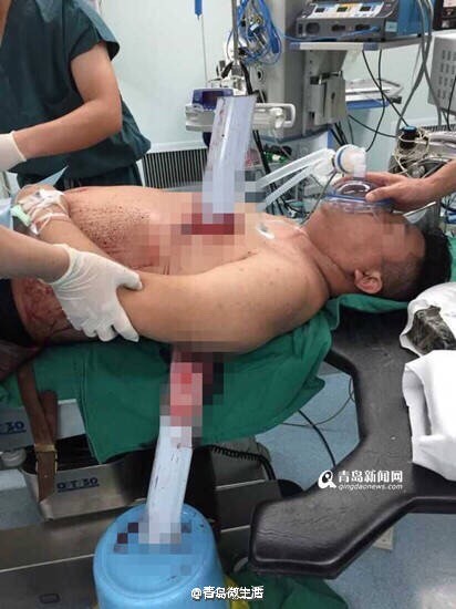黄岛男子驾车撞上护栏 断裂护栏刺穿胸腔