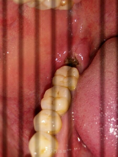 拔牙第三天，希望快点好