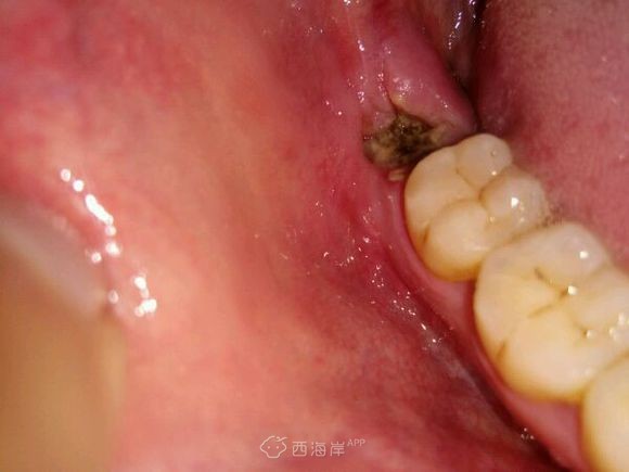 拔牙第三天，希望快点好