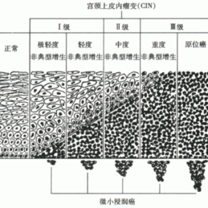 女性宫颈糜烂如何正确治疗？