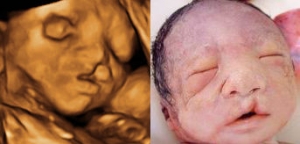 B超在产前筛查中的作用(组图)