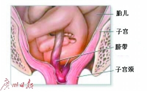 屡上头条的“脐带脱垂”究竟是啥？