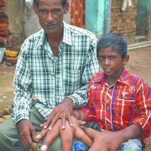 印8岁男童手比头，每只“巨手”重8斤