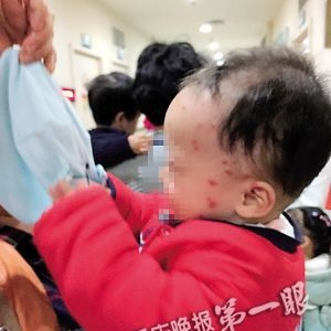 女婴满身红疙瘩，竟是螨虫在搞鬼