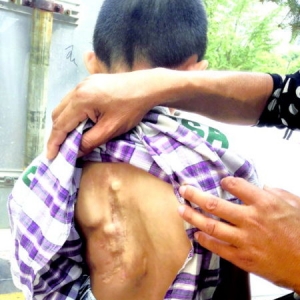 9岁男童脊柱侧弯7年做了20多次手术