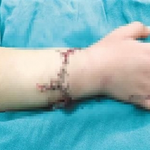 5岁女孩右手腕被连根切断，经6小时成功接上