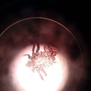 4岁女童左眼瘙痒数月，系虱子藏睫毛根部吸血
