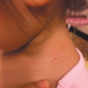 女童颈部现“针眼儿” 疑在幼儿园遭针扎