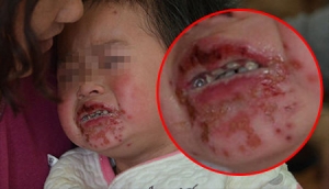 幼儿吃辣条烂嘴巴 辣条不仅影响发育更可能致癌
