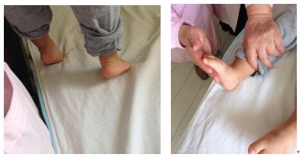 婴儿足尖着地是脑瘫的表现吗？