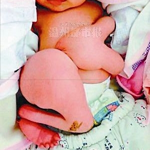 广东一新生儿，竟然4手4脚