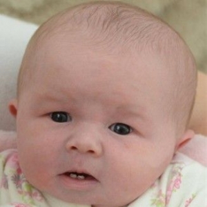 英一婴儿出生时即长出2颗门牙